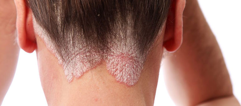 Hair-Transplant-in-Pakistan-For-Men-&-Women