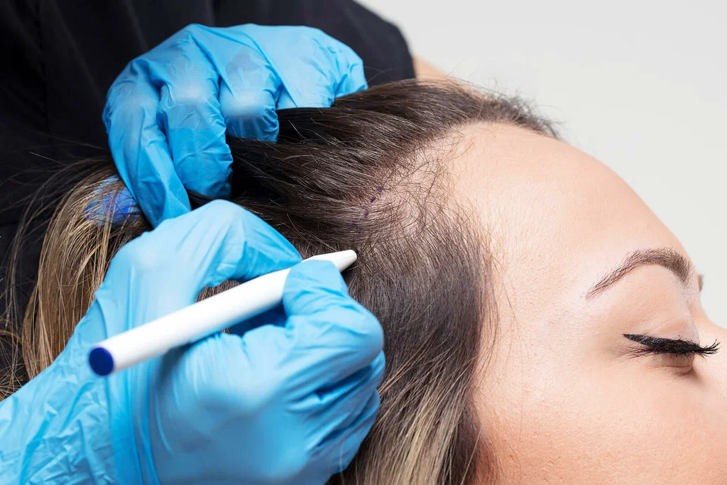 When Hair Loss Means It’s Time For Professional Treatment