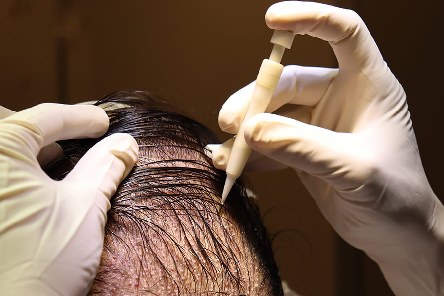 DHI Hair Transplant procedure for natural hair restoration