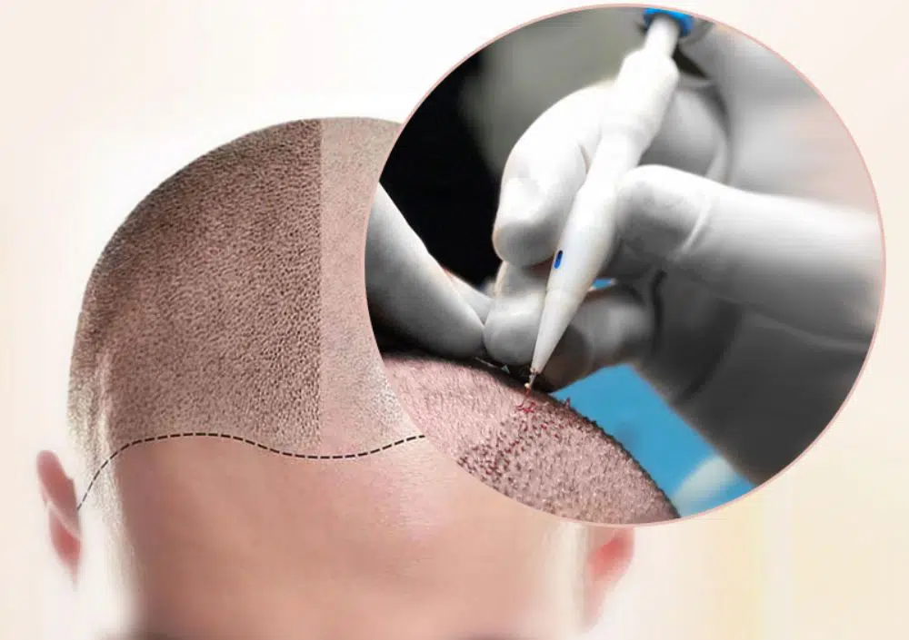 FUE and FUT hair transplant techniques comparison for hair restoration treatment