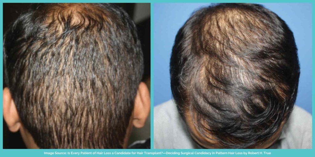 Hair restoration treatment for diffuse hair loss