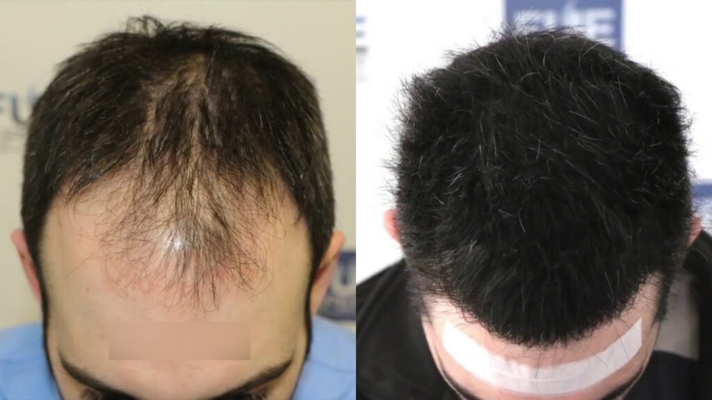 Hair transplant specialist planning follicle placement to cover bald areas.