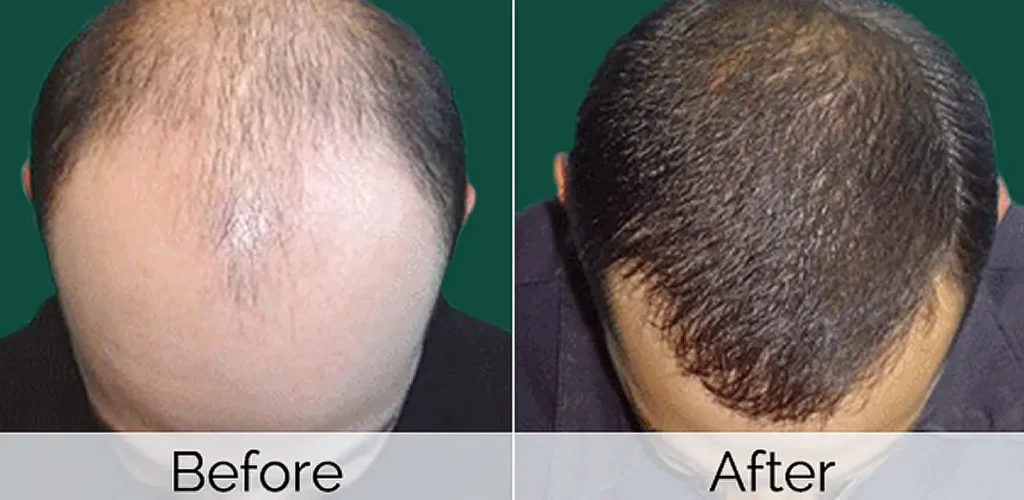Hair transplant patient showing new hair growth progress after treatment.