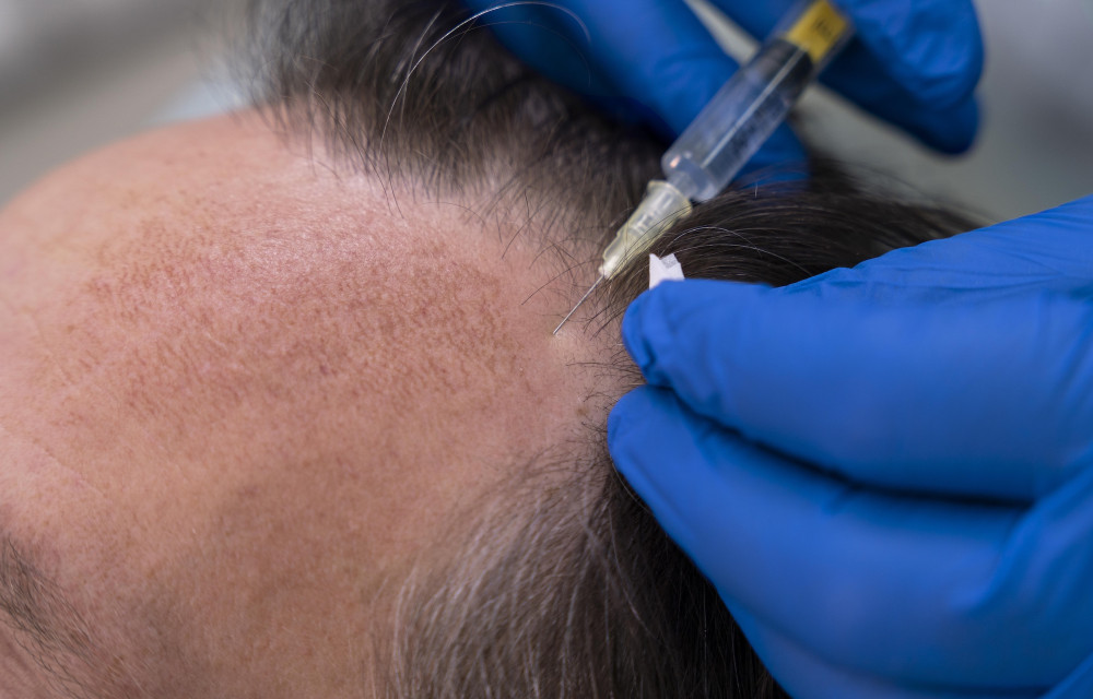 Signs of hair loss showing thinning areas, receding hairline, and need for hair transplant evaluation.