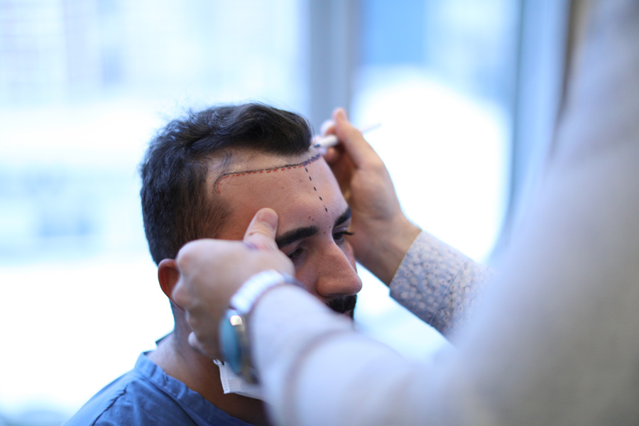 Hair fall causes and hair restoration treatment concept