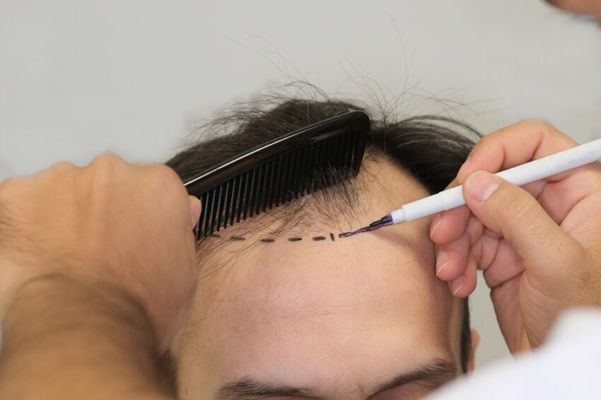 Surgeon checking graft survival after hair transplant procedure