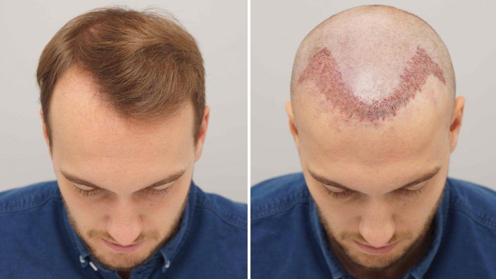 Specialist examining hair graft quality during a hair transplant procedure