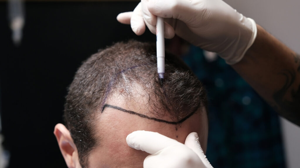 Hair transplant consultation with specialist evaluating hair loss and treatment plan