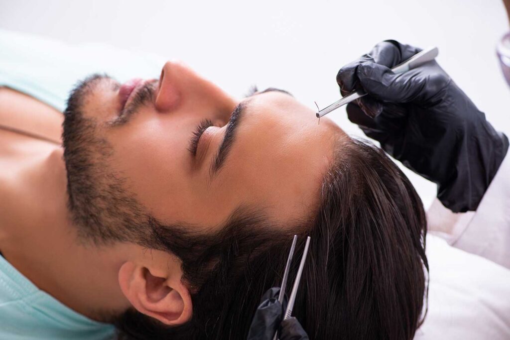 Hair transplant treatment for early hair loss and natural hair restoration results