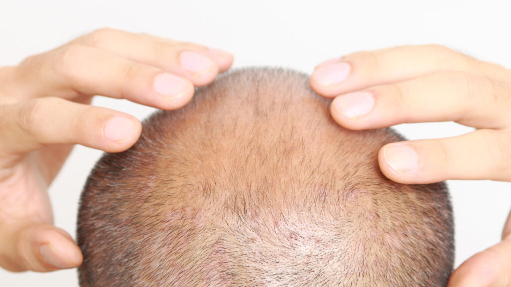 Shock loss after hair transplant causing temporary hair shedding